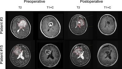 Resection of Noncontrast-Enhancing Regions Deteriorated the Immunotherapeutic Efficacy of HSPPC-96 Vaccination in Treating Glioblastoma